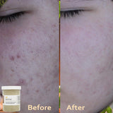 Acne Solution Kit for Face by Aniise